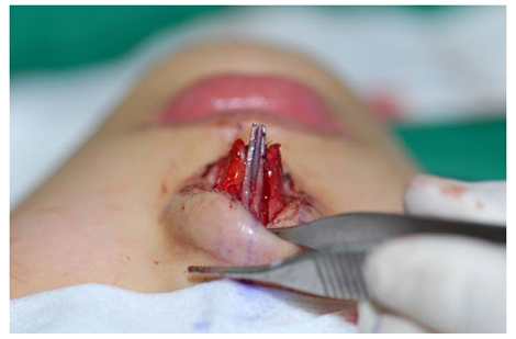 비중격 연골을 이용하여 쐐기 모양으로 대주는 확장이식 수술 중 사진